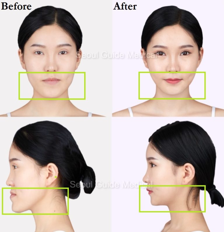 Before And After Double Jaw Surgery - Seoul Guide Medical