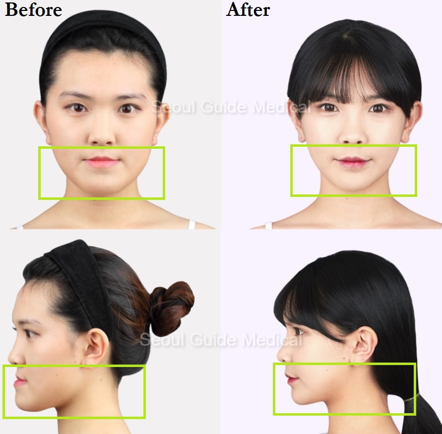 Before And After Double Jaw Surgery Seoul Guide Medical