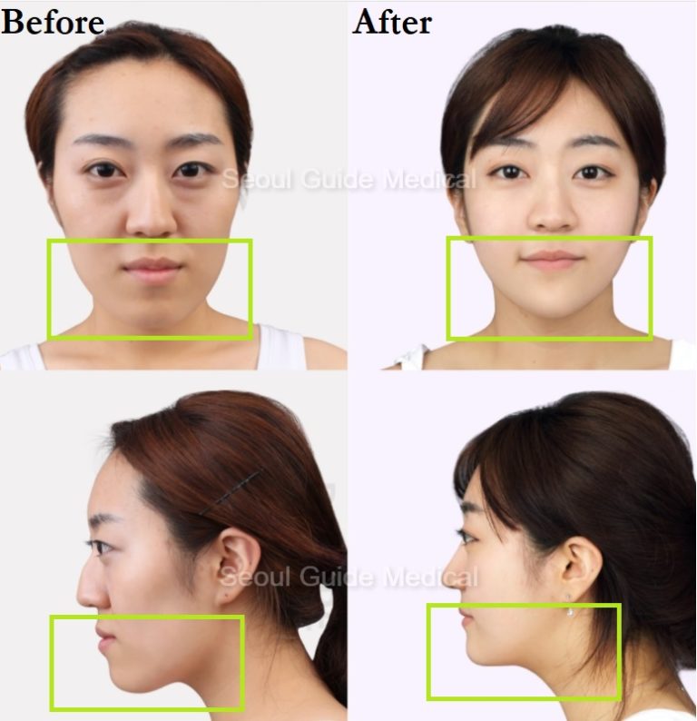 Before And After Double Jaw Surgery Seoul Guide Medical