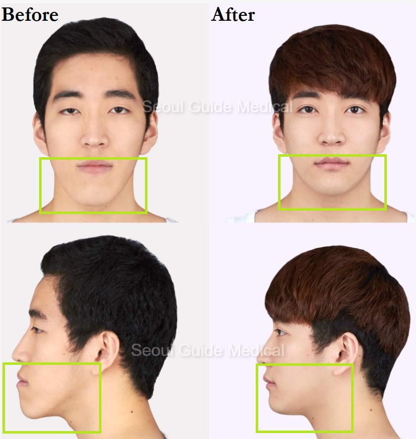 underbite surgery swelling