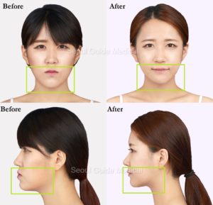 Before And After Double Jaw Surgery - Seoul Guide Medical