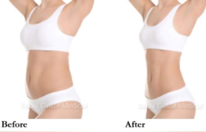 Achieve Your Body Goals With Full Body Liposuction in Korea This