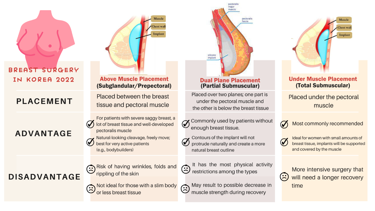 What Style of Breast Augmentation Suits You Best?