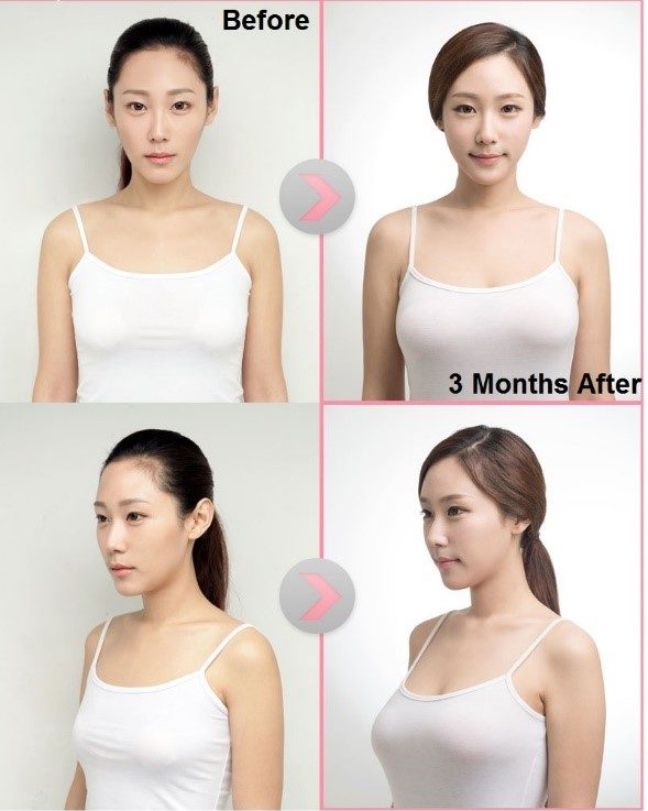 Breast augmentation in Korea - enhance size and shape